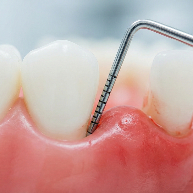 Diş Eti Hastalıkları Tedavisi